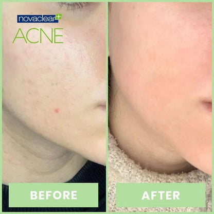 Novaclear Acne Kit With Acne Facial Foam 100ml + Acne Toner 150ml + Acne Cream For Oily, Combination & Acne-Prone Skin 40ml Novaclear
