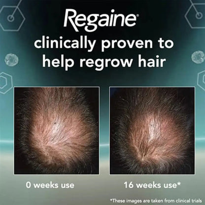 Regaine For Men 5% Extra Strength Topical Hair Regrowth Foam 73ml, Pack of 3's Regaine